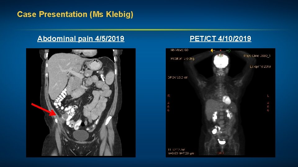 Case Presentation (Ms Klebig) Abdominal pain 4/5/2019 PET/CT 4/10/2019 
