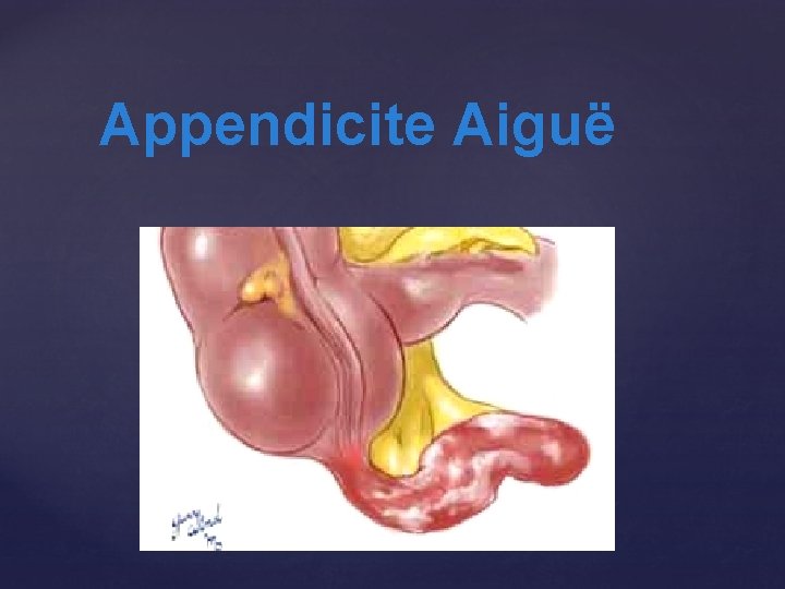  Appendicite Aiguë 