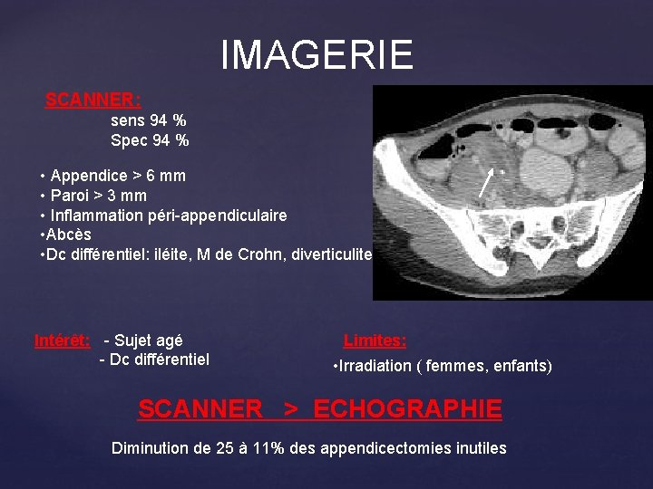 IMAGERIE SCANNER: sens 94 % Spec 94 % • Appendice > 6 mm •