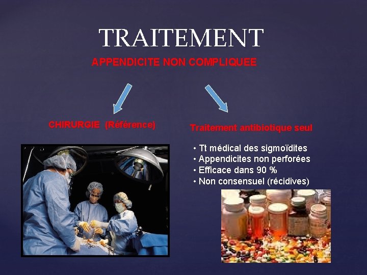 TRAITEMENT APPENDICITE NON COMPLIQUEE CHIRURGIE (Référence) Traitement antibiotique seul • Tt médical des sigmoïdites