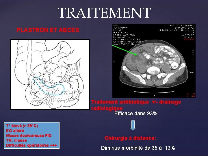 TRAITEMENT PLASTRON ET ABCES Traitement antibiotique +/- drainage radiologique Efficace dans 93% T° élevé