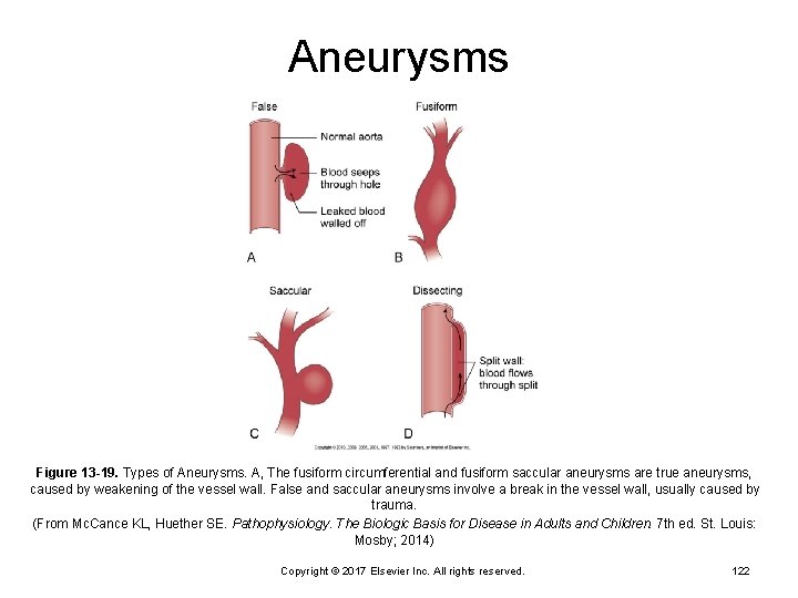 Aneurysms Figure 13 -19. Types of Aneurysms. A, The fusiform circumferential and fusiform saccular