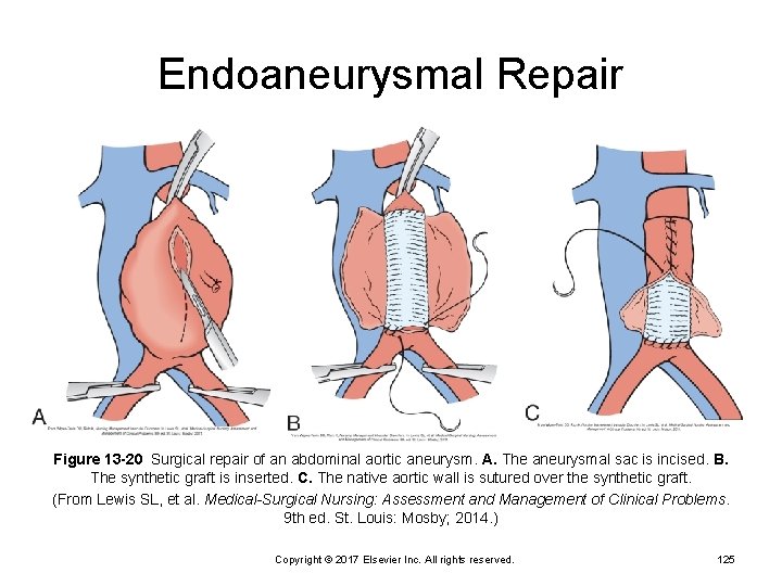 Endoaneurysmal Repair Figure 13 -20 Surgical repair of an abdominal aortic aneurysm. A. The aneurysmal