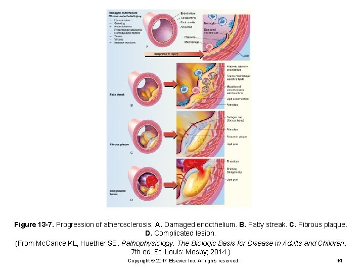 Figure 13 -7. Progression of atherosclerosis. A. Damaged endothelium. B. Fatty streak. C. Fibrous