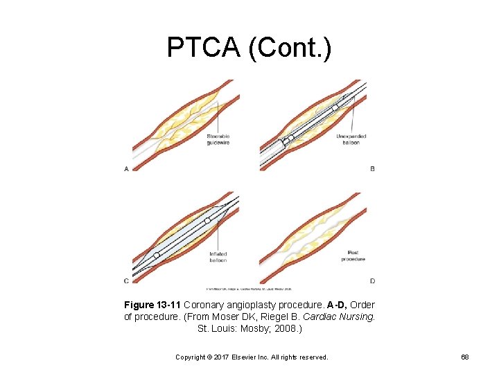 PTCA (Cont. ) Figure 13 -11 Coronary angioplasty procedure. A-D, Order of procedure. (From