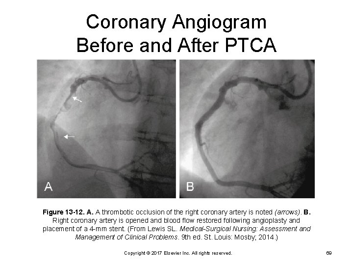 Coronary Angiogram Before and After PTCA Figure 13 -12. A. A thrombotic occlusion of