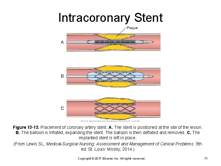 Intracoronary Stent Figure 13 -13. Placement of coronary artery stent. A. The stent is