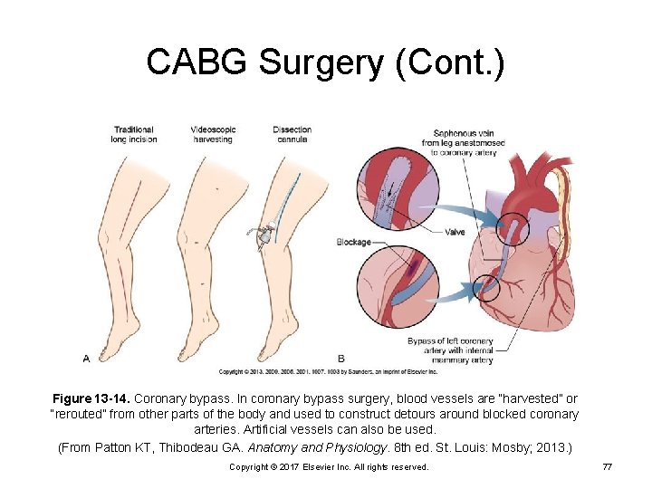 CABG Surgery (Cont. ) Figure 13 -14. Coronary bypass. In coronary bypass surgery, blood