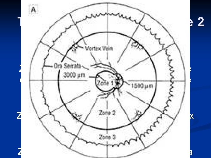 The vortex veins divide Zone 2 from Zone 3 Zone 1: within 1500 microns
