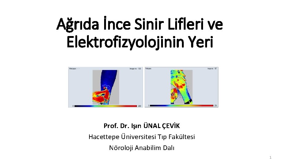 Ağrıda İnce Sinir Lifleri ve Elektrofizyolojinin Yeri Prof. Dr. Işın ÜNAL ÇEVİK Hacettepe Üniversitesi