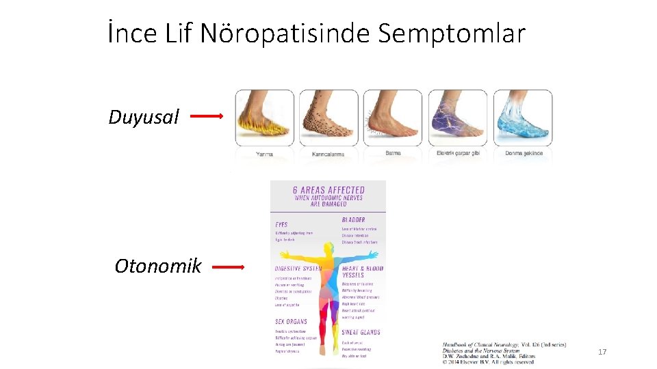 İnce Lif Nöropatisinde Semptomlar Duyusal Otonomik 17 