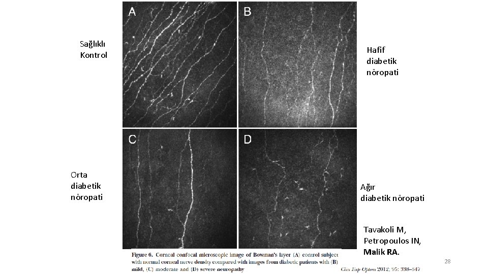 Sağlıklı Kontrol Orta diabetik nöropati Hafif diabetik nöropati Ağır diabetik nöropati Tavakoli M, Petropoulos