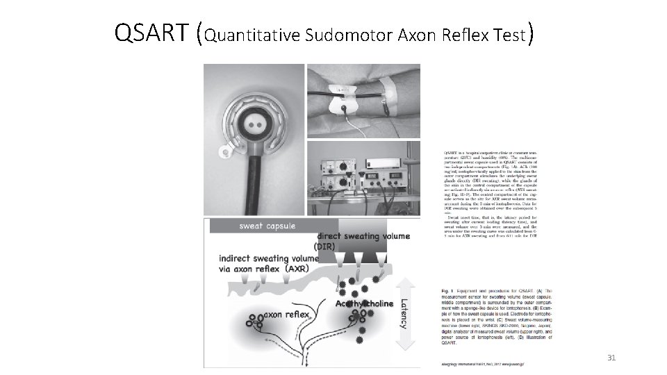 QSART (Quantitative Sudomotor Axon Reflex Test) 31 