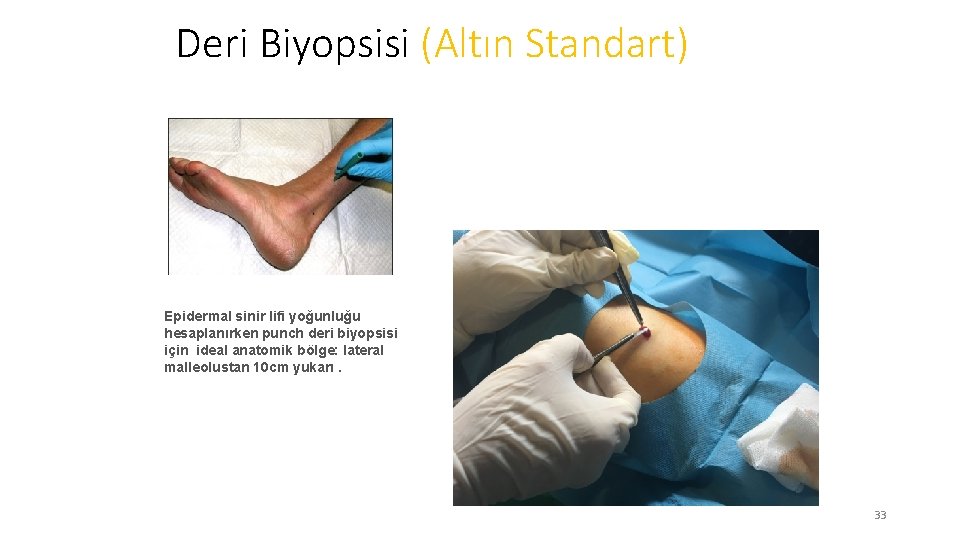 Deri Biyopsisi (Altın Standart) Epidermal sinir lifi yoğunluğu hesaplanırken punch deri biyopsisi için ideal