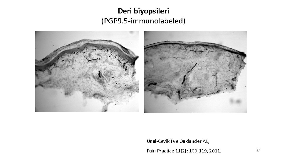 Deri biyopsileri (PGP 9. 5 -immunolabeled) Unal-Cevik I ve Oaklander AL, Pain Practice 11(2):