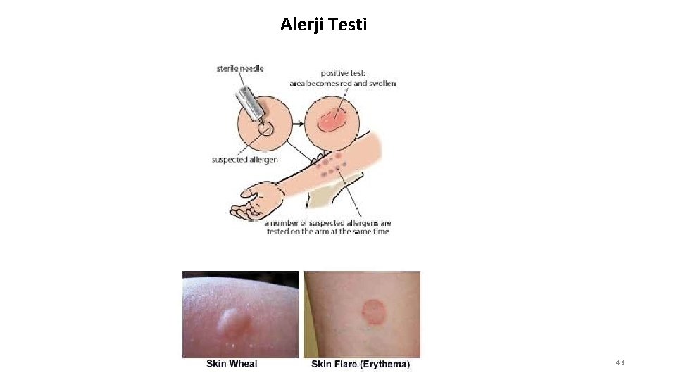 Alerji Testi 43 