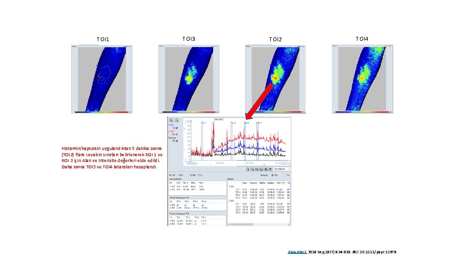 TOI 1 TOI 3 TOI 2 TOI 4 Histamin/kapsaisin uygulandıktan 5 dakika sonra (TOI