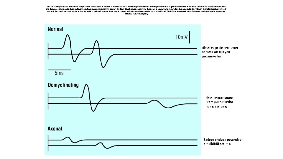 Muscle action potentials after distal and proximal stimulation of a nerve to a muscle