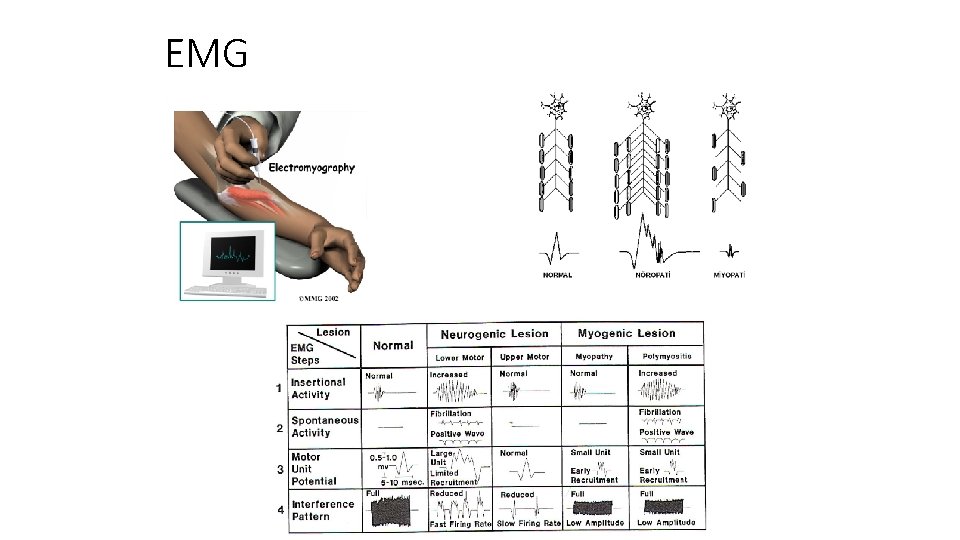 EMG 