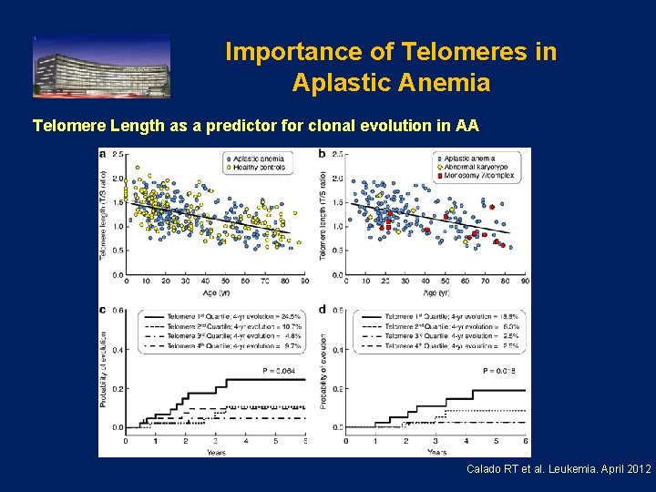 Importance of Telomeres in Aplastic Anemia Telomere Length as a predictor for clonal evolution