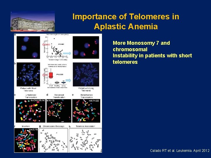 Importance of Telomeres in Aplastic Anemia More Monosomy 7 and chromosomal Instability in patients