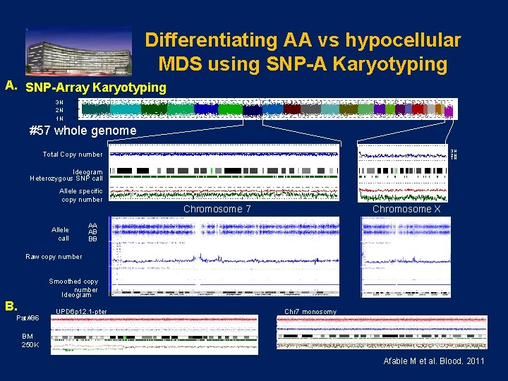 Differentiating AA vs hypocellular MDS using SNP-A Karyotyping A. SNP-Array Karyotyping 3 N 2