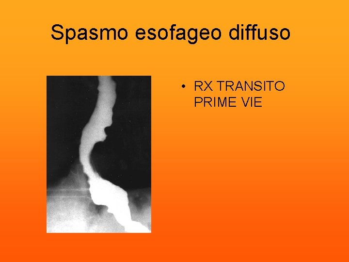 Spasmo esofageo diffuso • RX TRANSITO PRIME VIE 