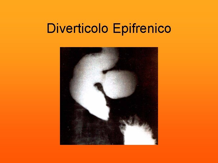 Diverticolo Epifrenico 