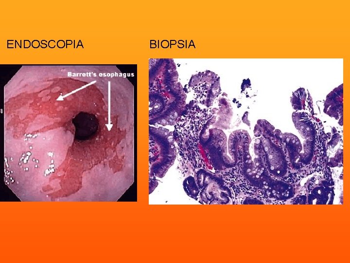 ENDOSCOPIA BIOPSIA 