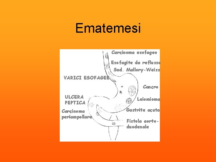 Ematemesi Carcinoma esofageo Esofagite da reflusso Snd. Mallory-Weiss VARICI ESOFAGEE Cancro ULCERA PEPTICA Carcinoma