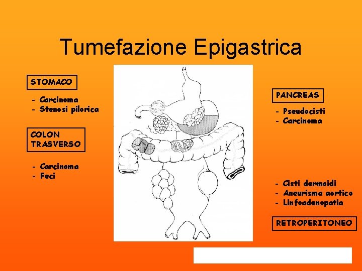 Tumefazione Epigastrica STOMACO - Carcinoma - Stenosi pilorica PANCREAS - Pseudocisti - Carcinoma COLON