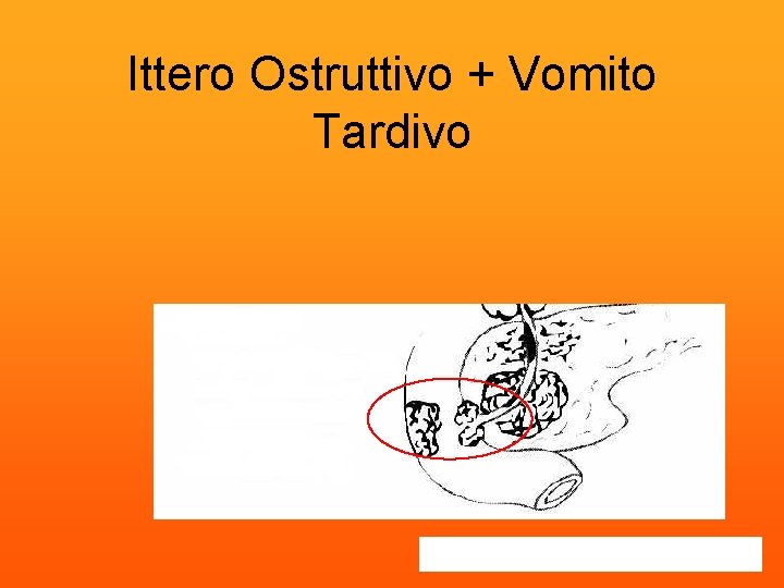 Ittero Ostruttivo + Vomito Tardivo 