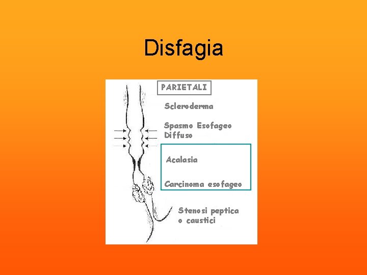 Disfagia PARIETALI Scleroderma Spasmo Esofageo Diffuso Acalasia Carcinoma esofageo Stenosi peptica o caustici 