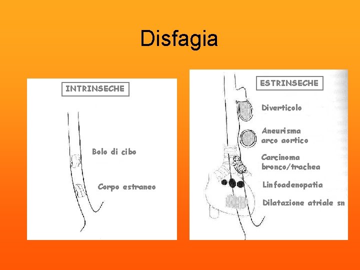 Disfagia INTRINSECHE ESTRINSECHE Diverticolo Aneurisma arco aortico Bolo di cibo Corpo estraneo Carcinoma bronco/trachea