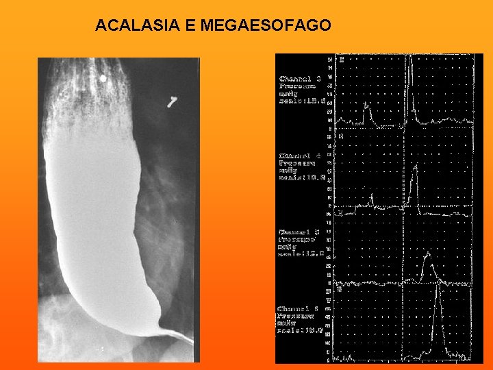 ACALASIA E MEGAESOFAGO 