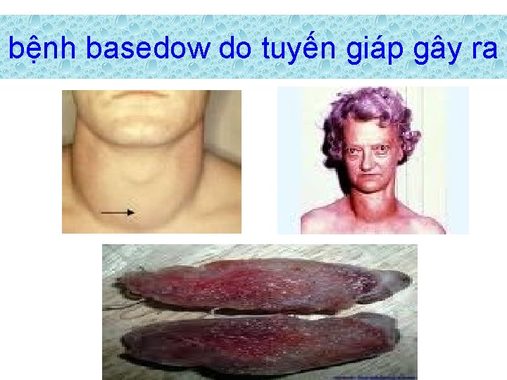 bệnh basedow do tuyến giáp gây ra 