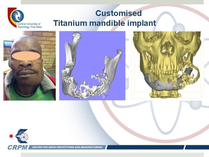 Customised Titanium mandible implant 