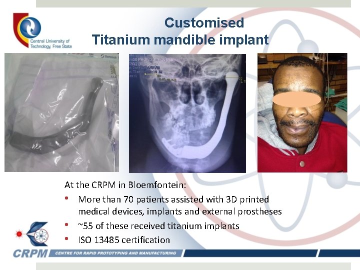 Customised Titanium mandible implant At the CRPM in Bloemfontein: • More than 70 patients