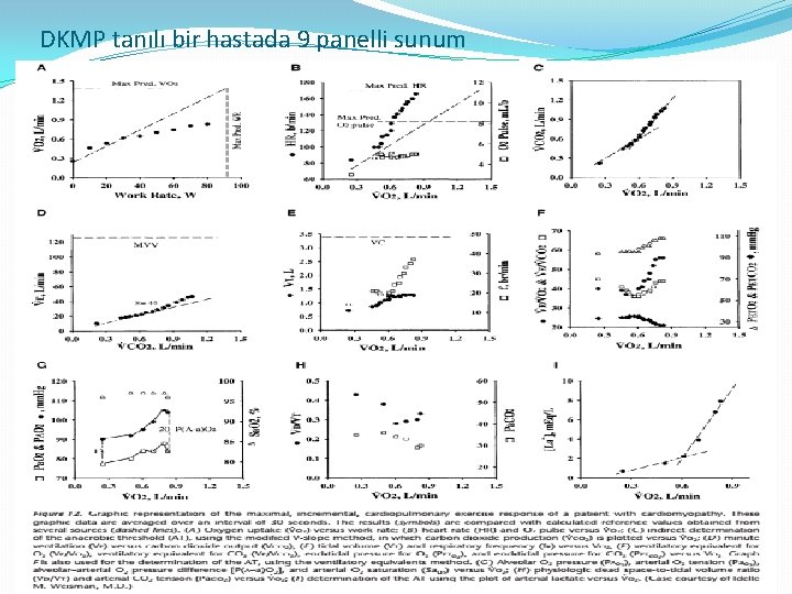 DKMP tanılı bir hastada 9 panelli sunum 