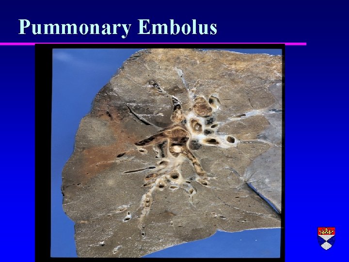 Pummonary Embolus 
