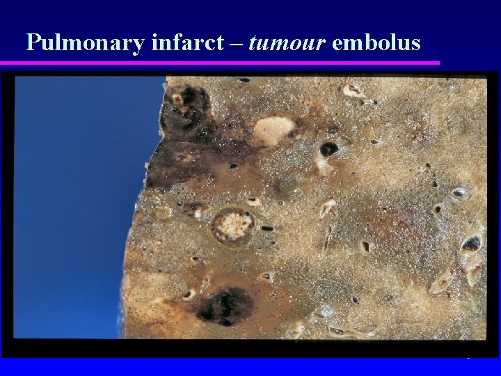Pulmonary infarct – tumour embolus 