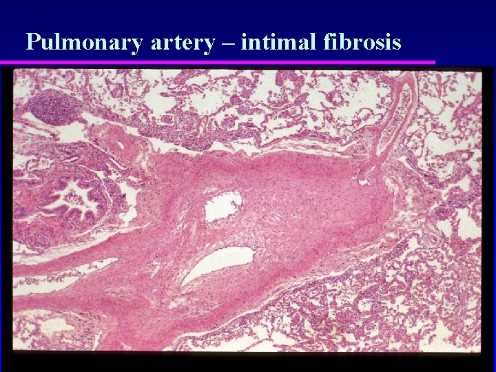 Pulmonary artery – intimal fibrosis 