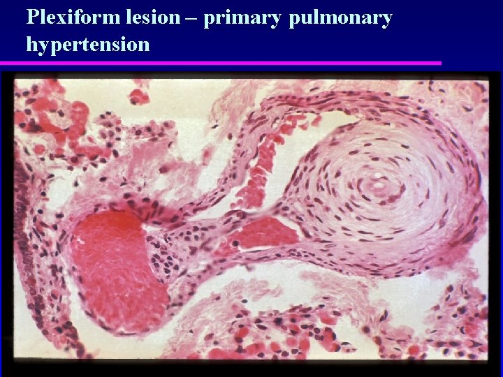 Plexiform lesion – primary pulmonary hypertension 