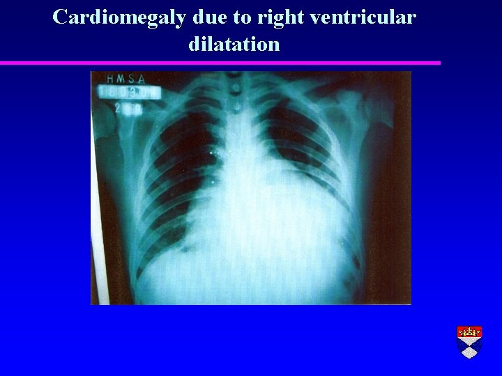 Cardiomegaly due to right ventricular dilatation 