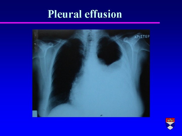 Pleural effusion 