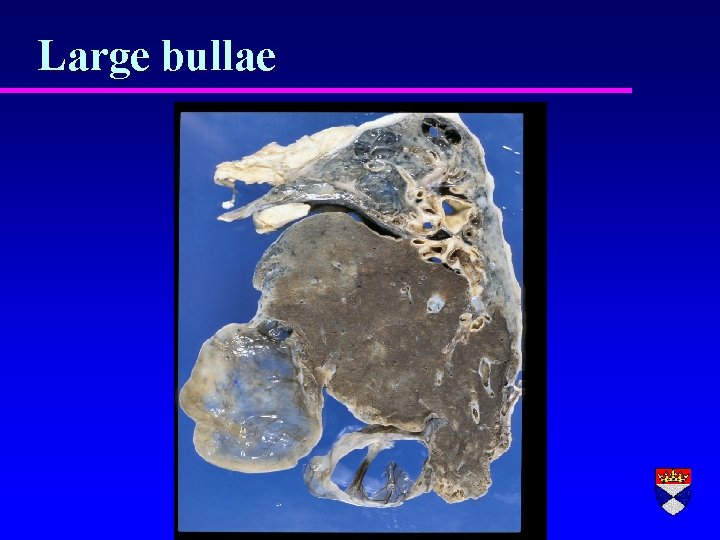 Large bullae 