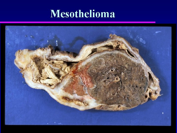 Mesothelioma 