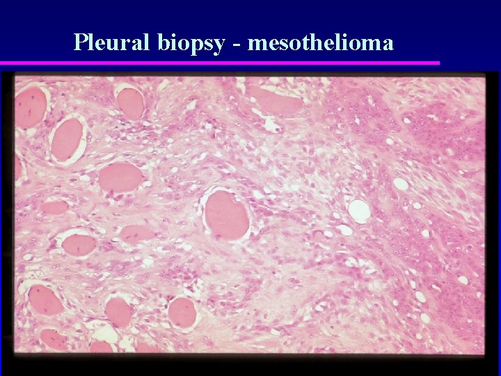Pleural biopsy - mesothelioma 