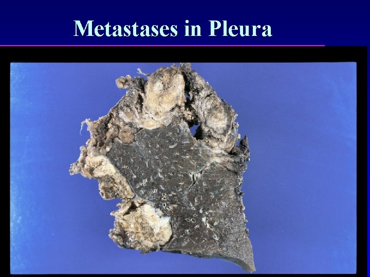 Metastases in Pleura 