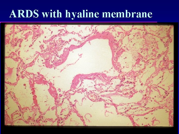 ARDS with hyaline membrane 